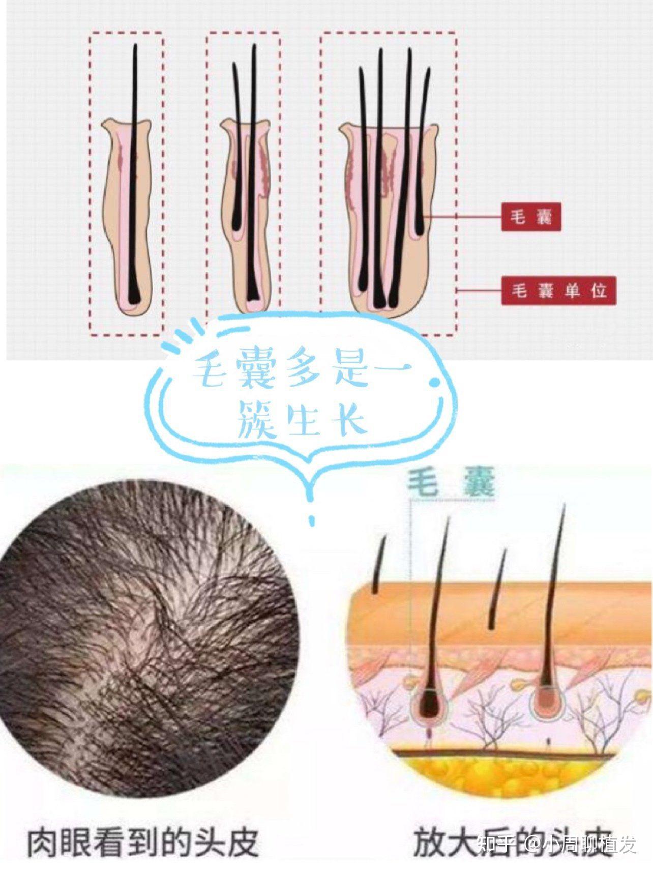 植发3000个毛囊图图片