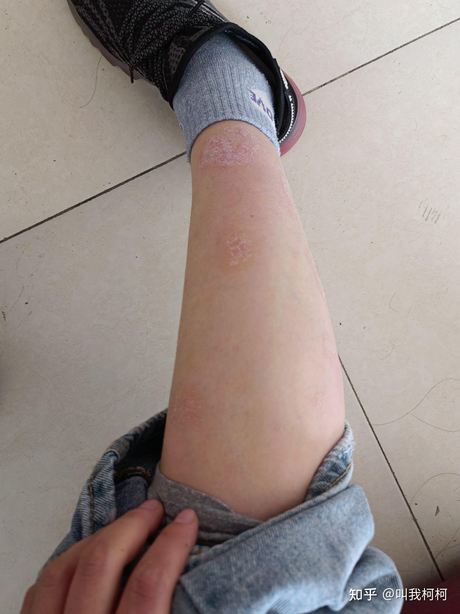 银屑病患者记录阿达木单抗使用