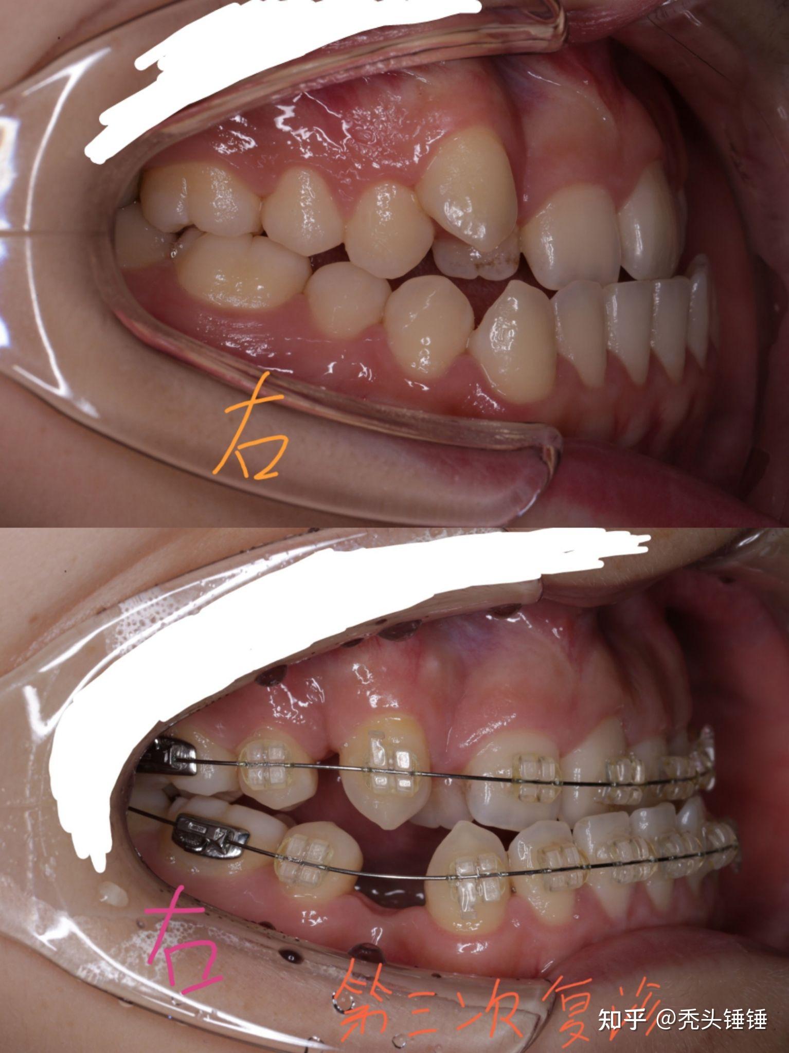 牙齿骨性反颌矫正记录给自己