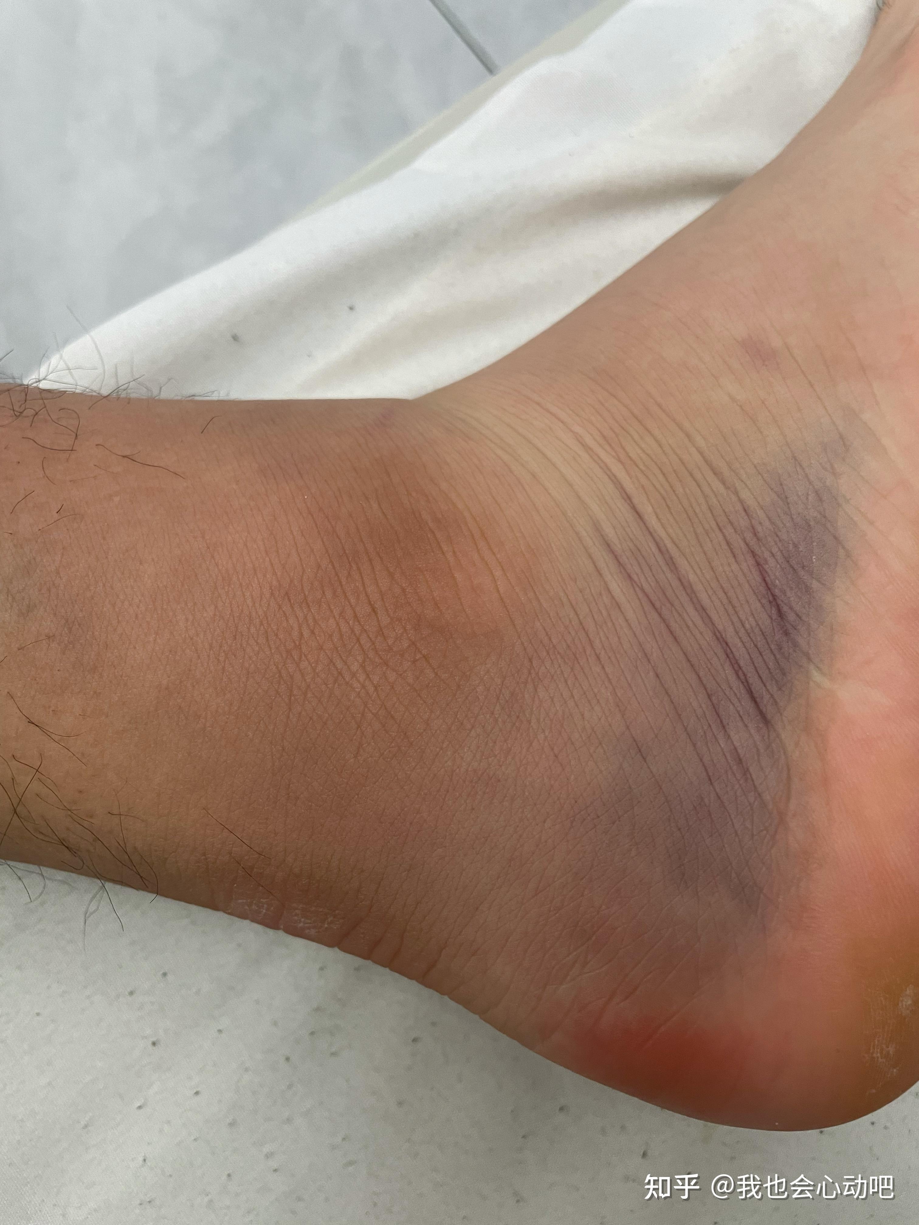 脚崴了肿了如果不及时处理会怎样