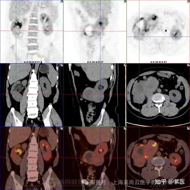 腹中见雷——巨大脂肪肉瘤的PET/CT影像 - 知乎