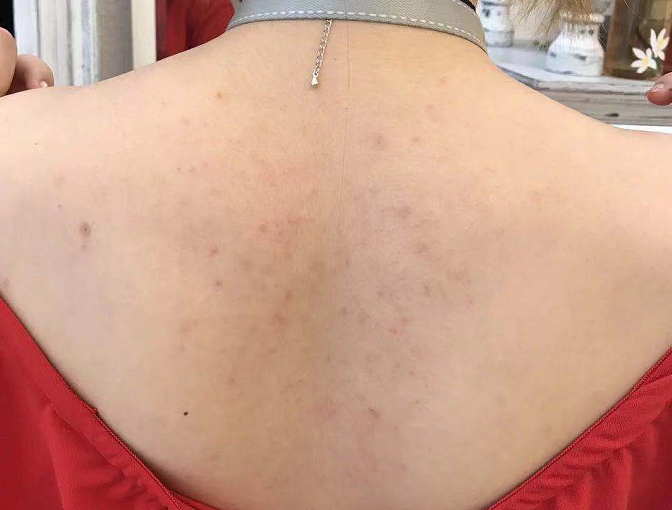 后背上长的都是青春痘,多喝水,多调整作息后背的痘痘就能自己消下去