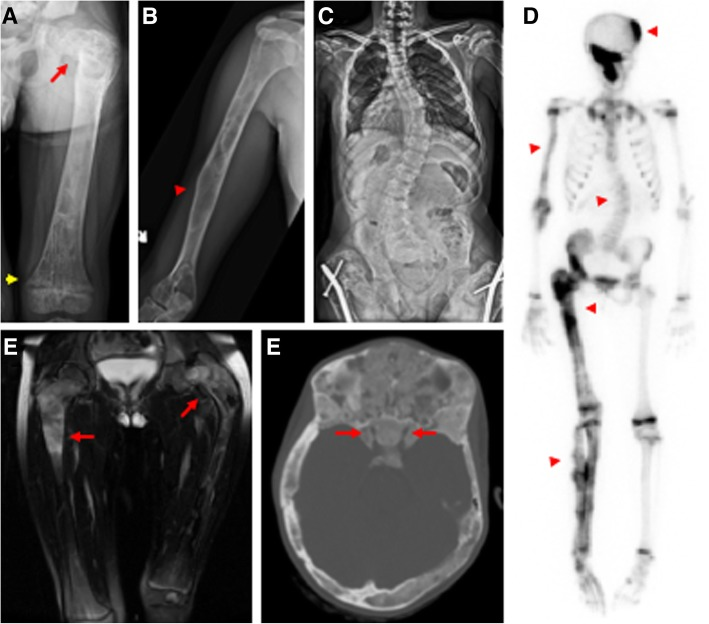 再论骨纤维结构不良骨纤维异常增殖症需要治疗吗怎么治疗