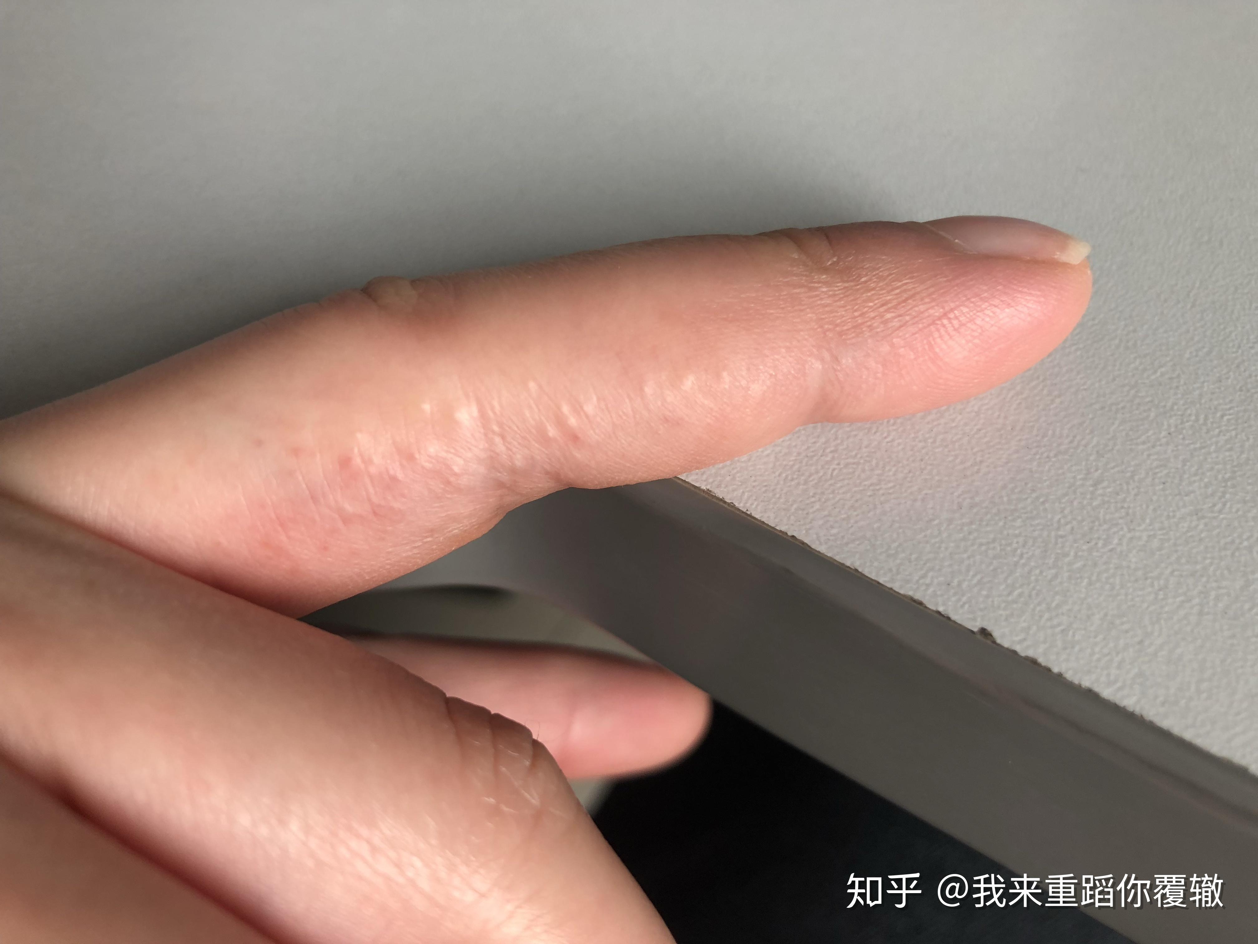 汗疱疹的病因是什么是真菌感染吗