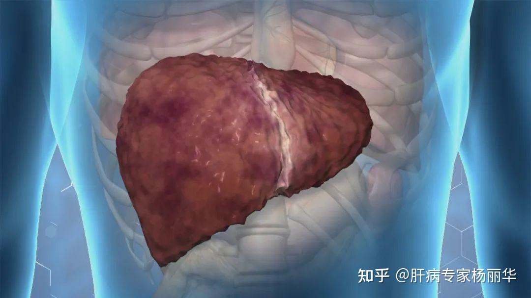 肝硬化患者为什么会产生腹水呢? - 知乎