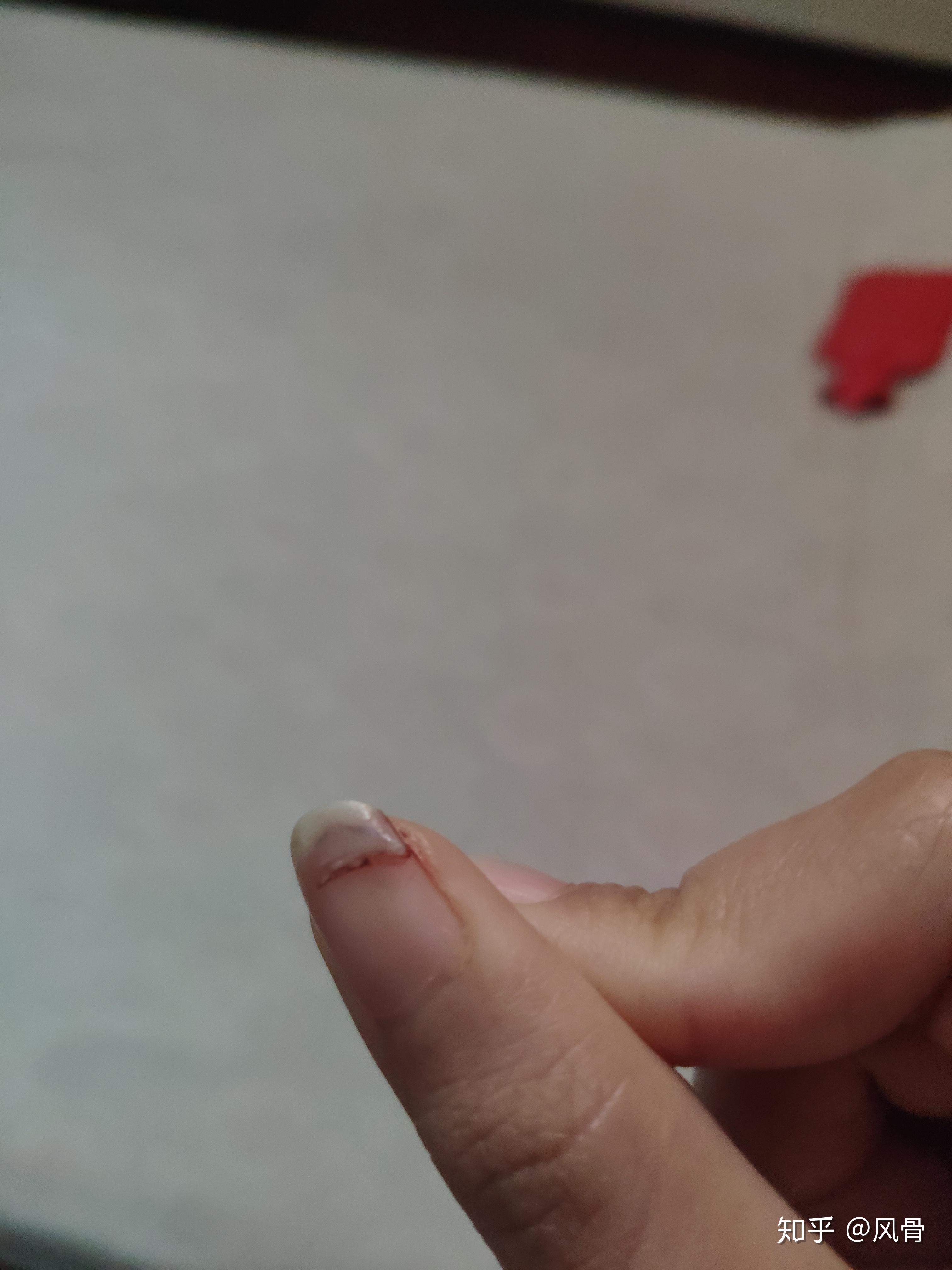 手指甲被砸是一种什么样的体验? - 知乎