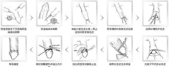 深圳都安全是采用什么方式来做包皮手术