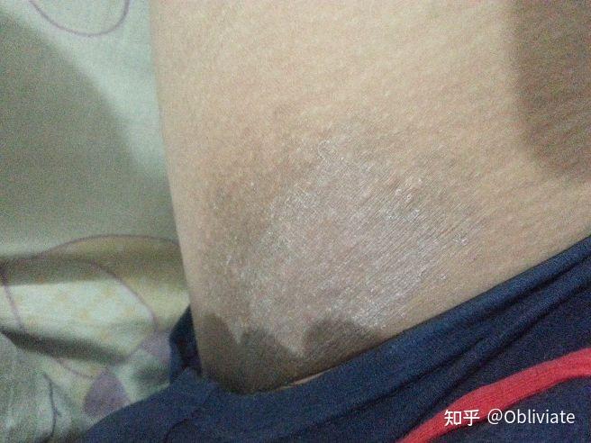 股藓黑色素沉淀?