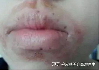 口周皮炎到底是什么? - 知乎