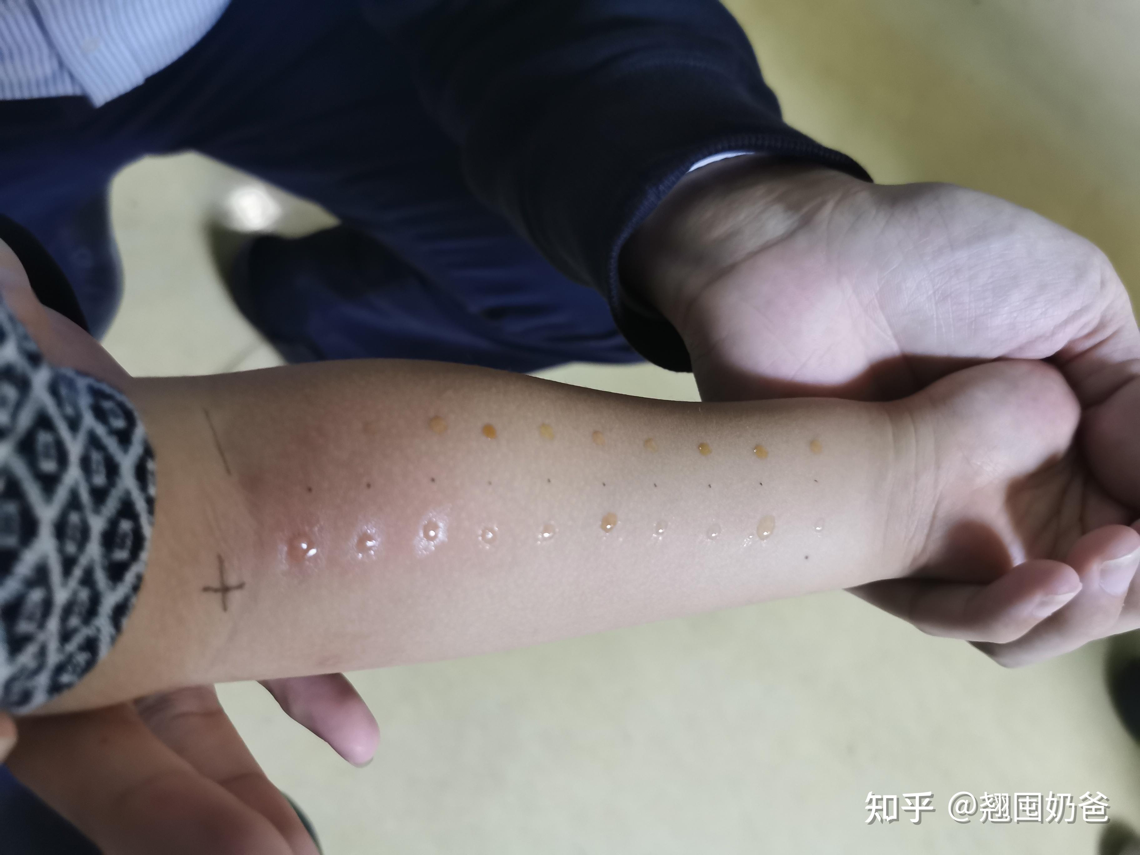 孩子过敏性鼻炎,总流鼻血,不吃药的土法上阵还有点用! - 知乎