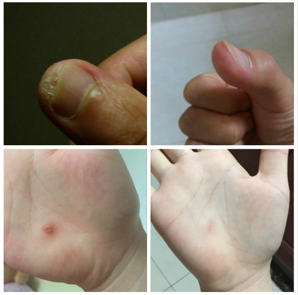 手指上长了个硬疙瘩好几年了不知道是什么