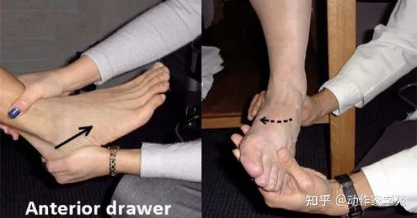 不过也最容易受伤,因此第一时间给她进行了踝关节前抽屉试验,判断有无