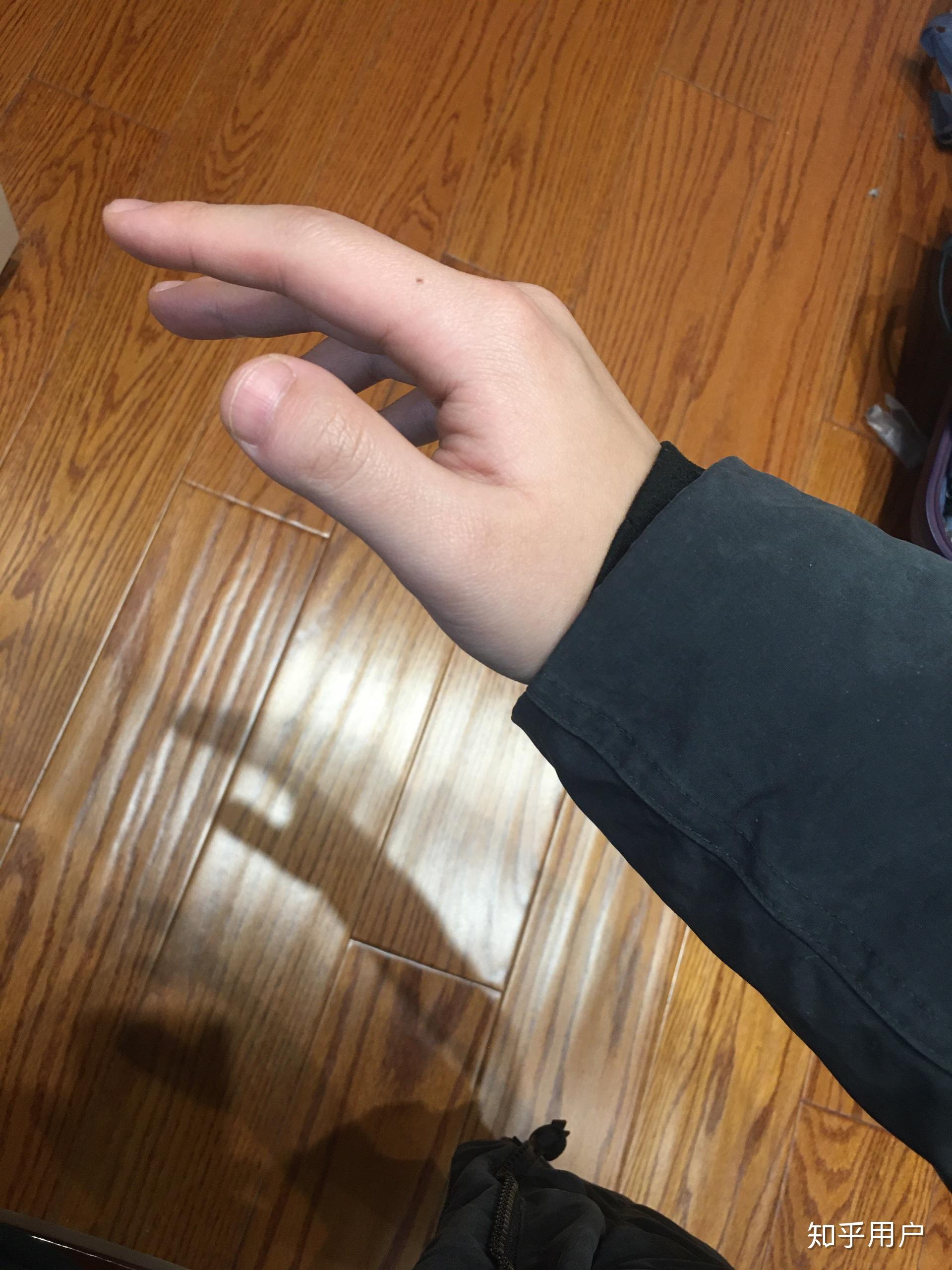 为什么我的大拇指又宽又短?