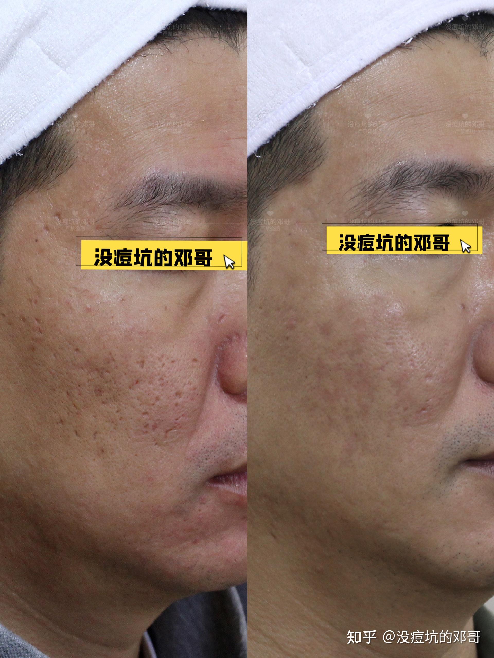 皮下分离治疗出现"增生"了?看看这组综合修复的效果