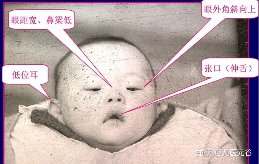 大家帮我看看是不是我孩子是不是糖宝 有人说我孩子看着不正常 像糖宝