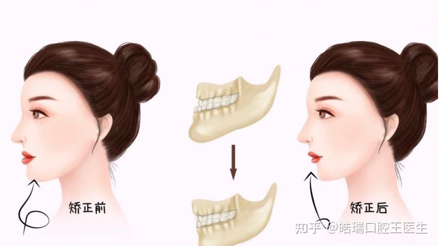 矫正牙齿真的会让脸型有明显的变化吗?正畸可以改变这些地方! ! ! - 知乎