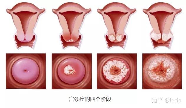 宫颈癌照片 女性图片