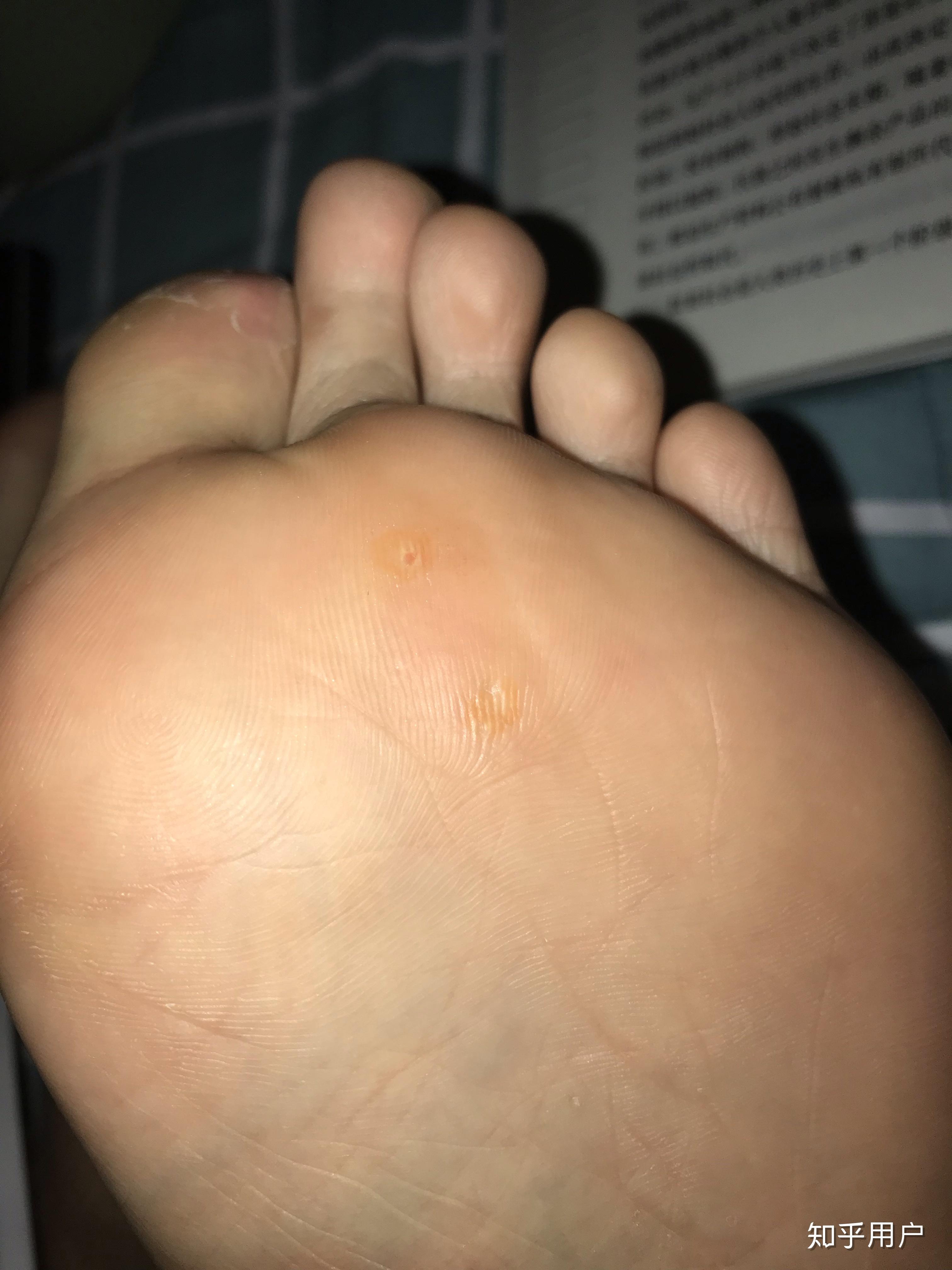 脚上长了鸡眼怎么才能治好呢