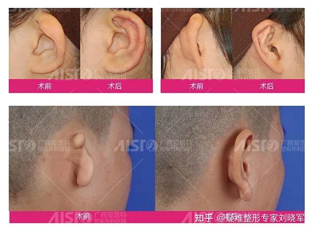 疑难整形专家刘晓军 67 第一军医大学医学博士 小耳畸形矫正手术