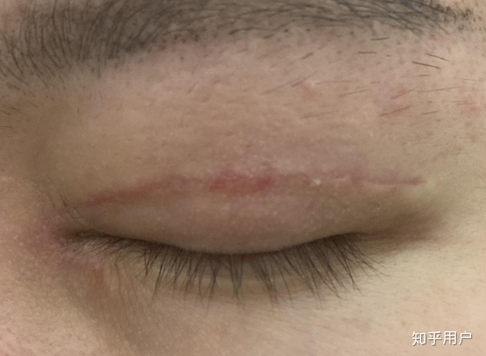2019.6.13 双眼皮手术全过程+拆线及术后恢复-更新中 - 知乎