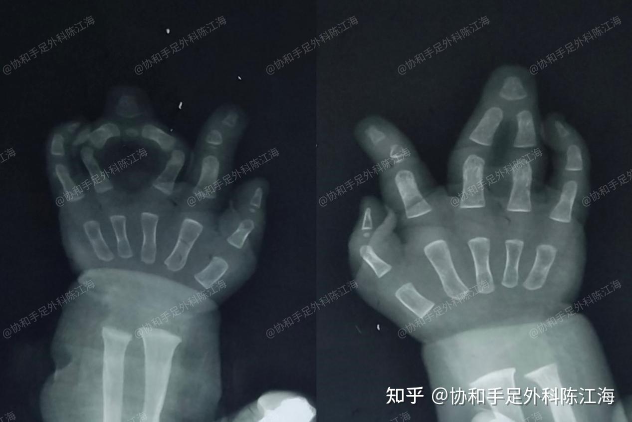 并指免植皮 | 案例14《“菱形”并指分开之后,小手力量很不错》 - 知乎