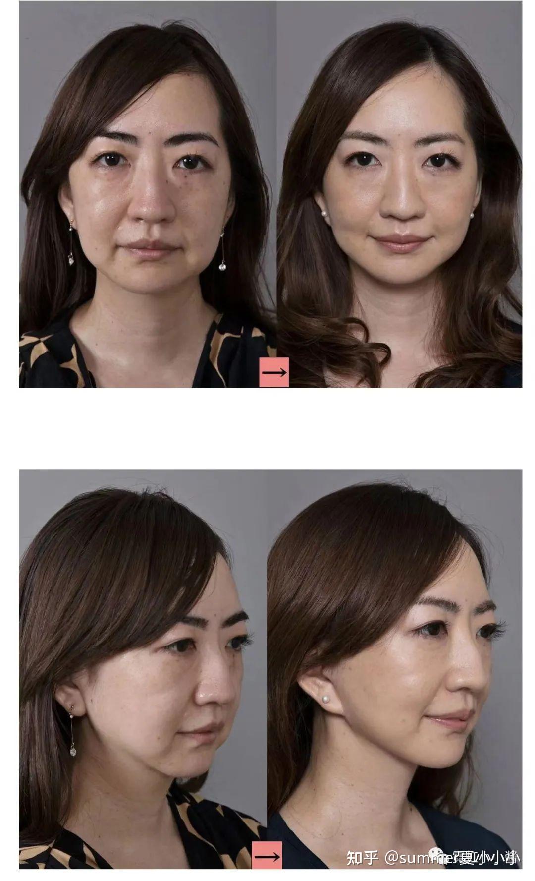 有谁知道做一次大拉皮手术要多少钱