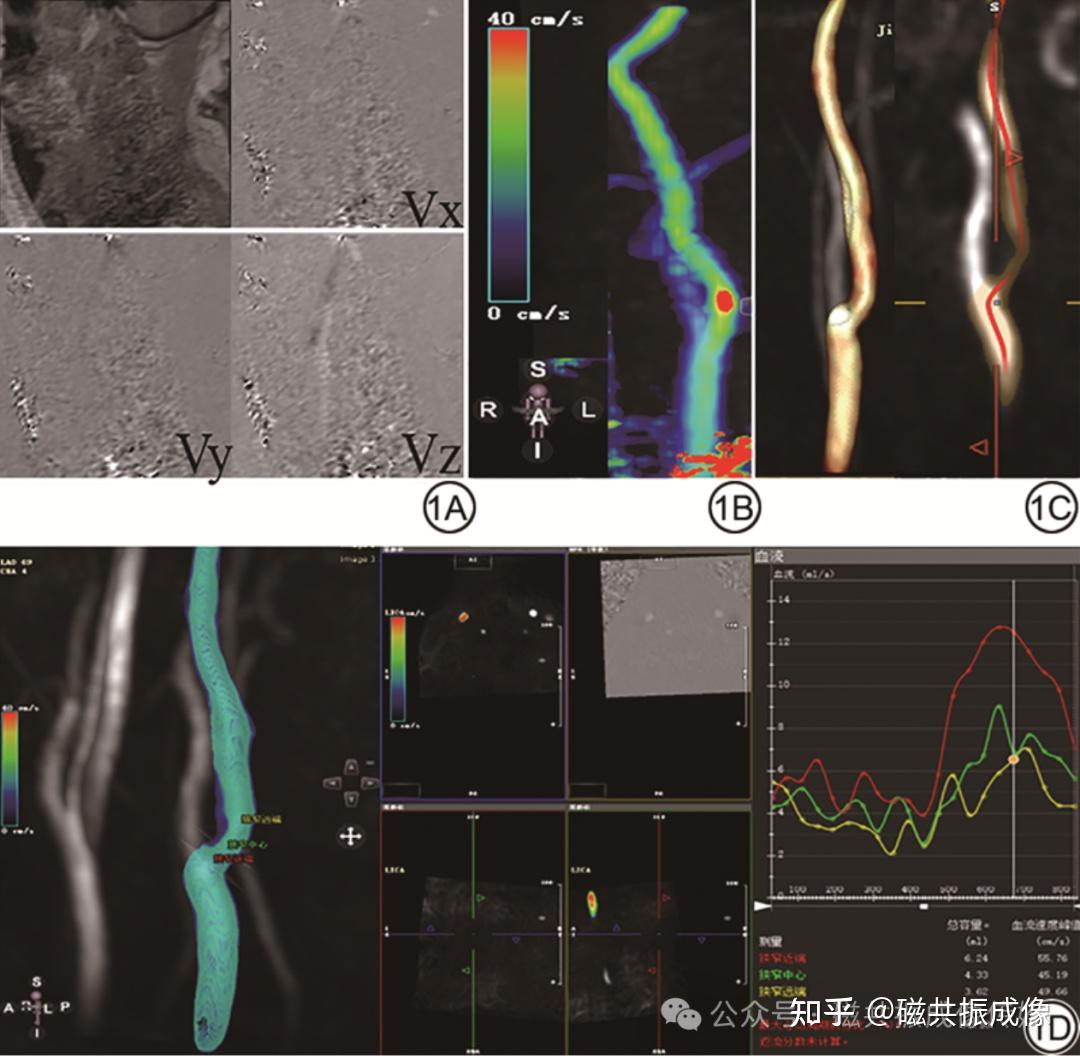 4D Flow MRI评估颈动脉狭窄及卒中相关血流动力学危险因素的研究 - 知乎