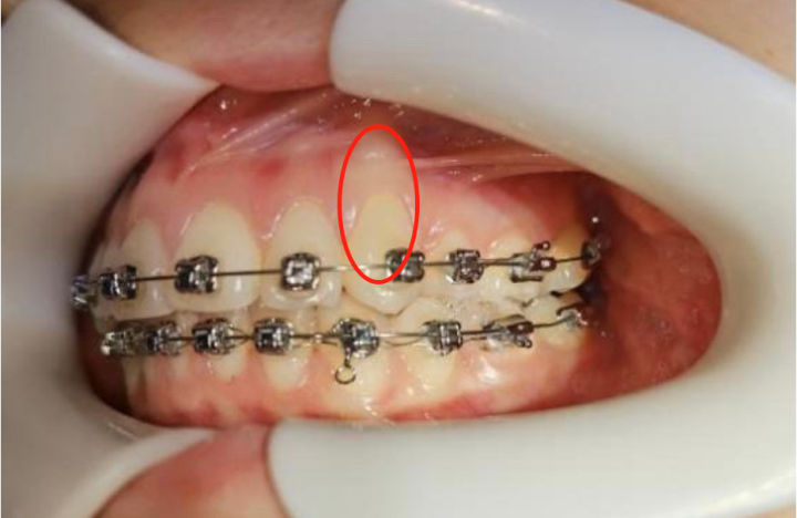 能否科普一下"骨开窗"? - 知乎