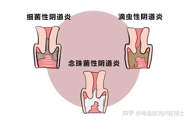 怎样通过阴道分泌物判断阴道炎的几大类别