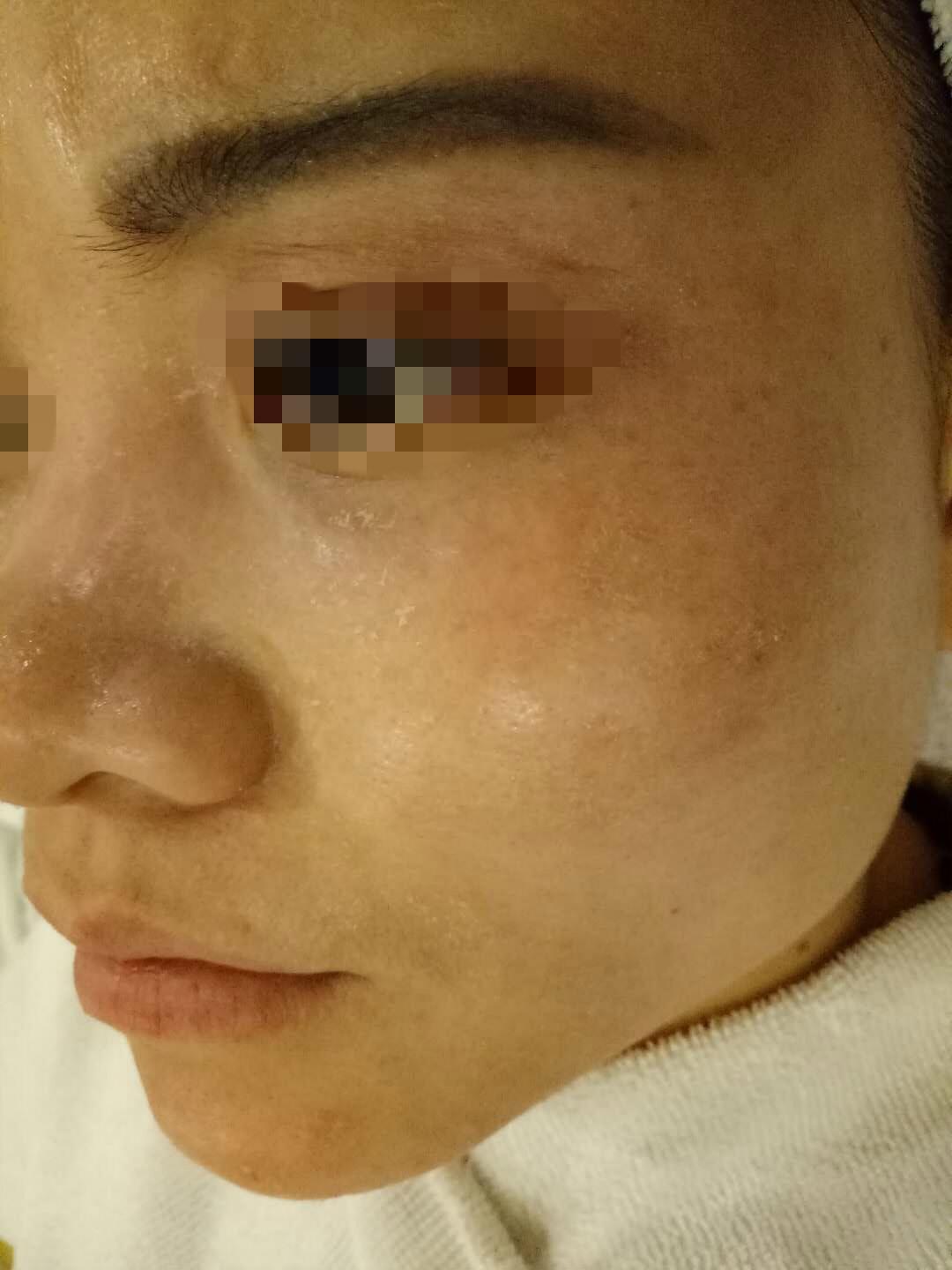 干敏到皮肤脱皮发黑修复案例