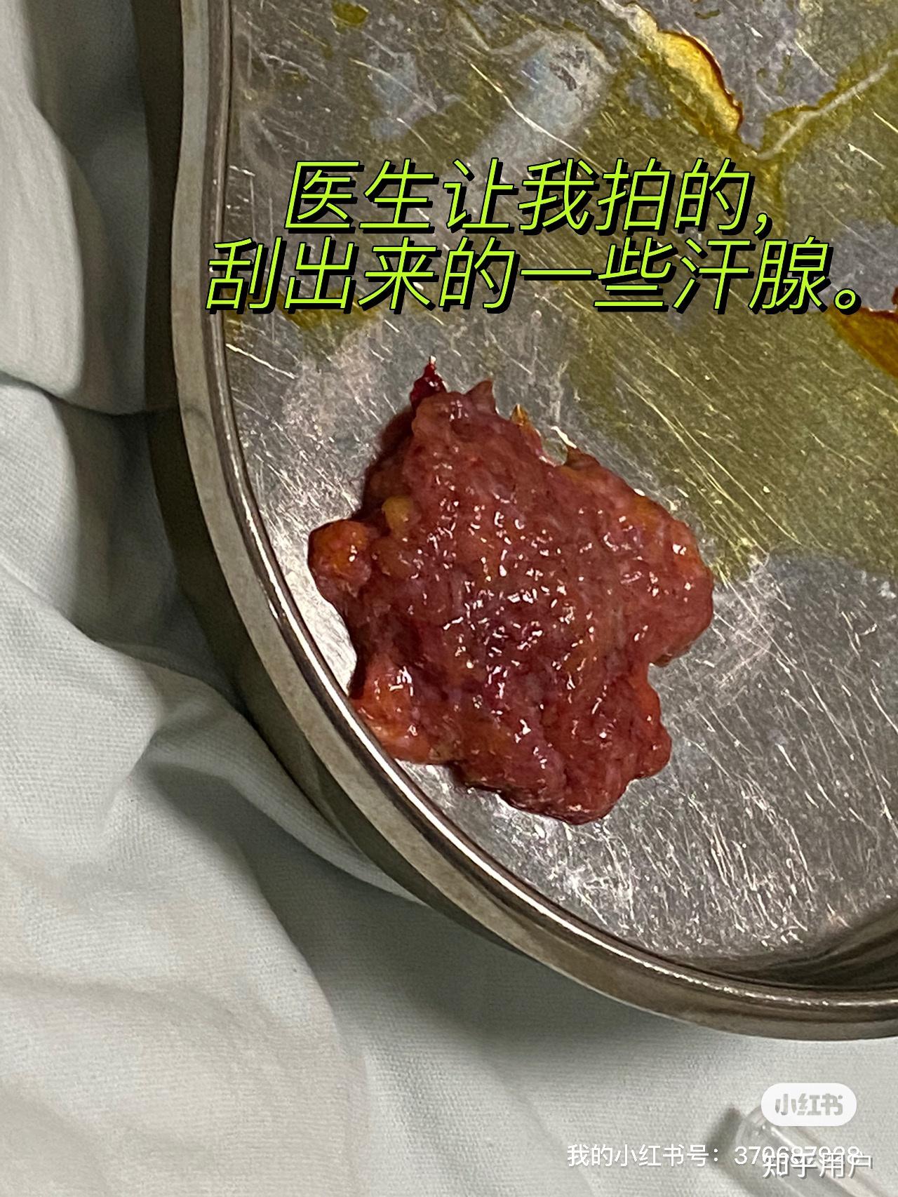 做腋下大汗腺切除手術是什麼體驗? - 知乎