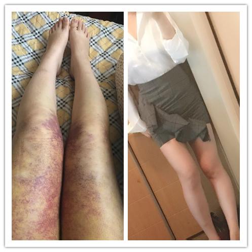 上海大腿环吸价格24000吸脂惨烈教训慎重选择吧