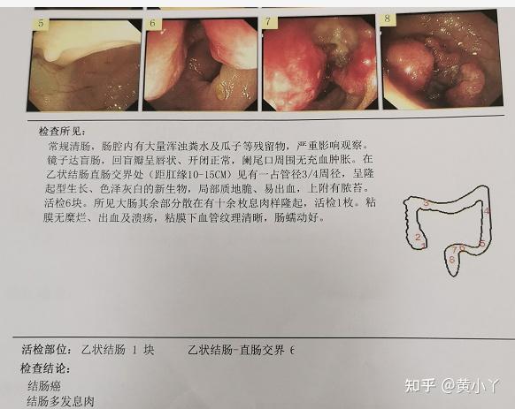 爸爸的癌症治療之路結腸癌伴肝轉移