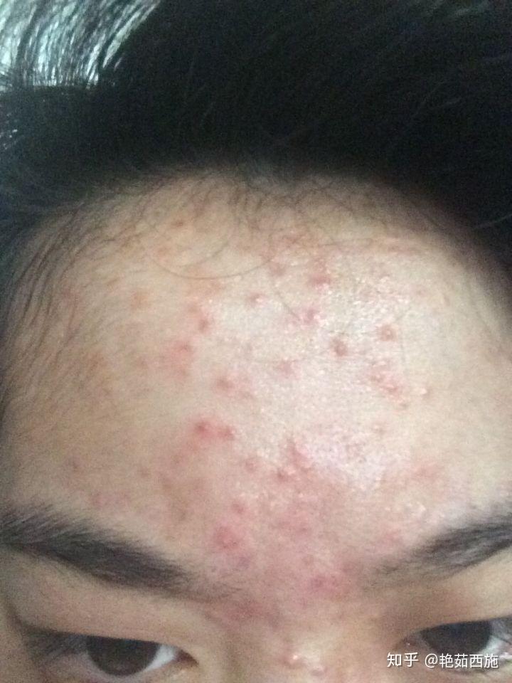 粉刺怎么消除才能彻底 v2-24f2718f82765097a32003eeec30b994_r.jpg
