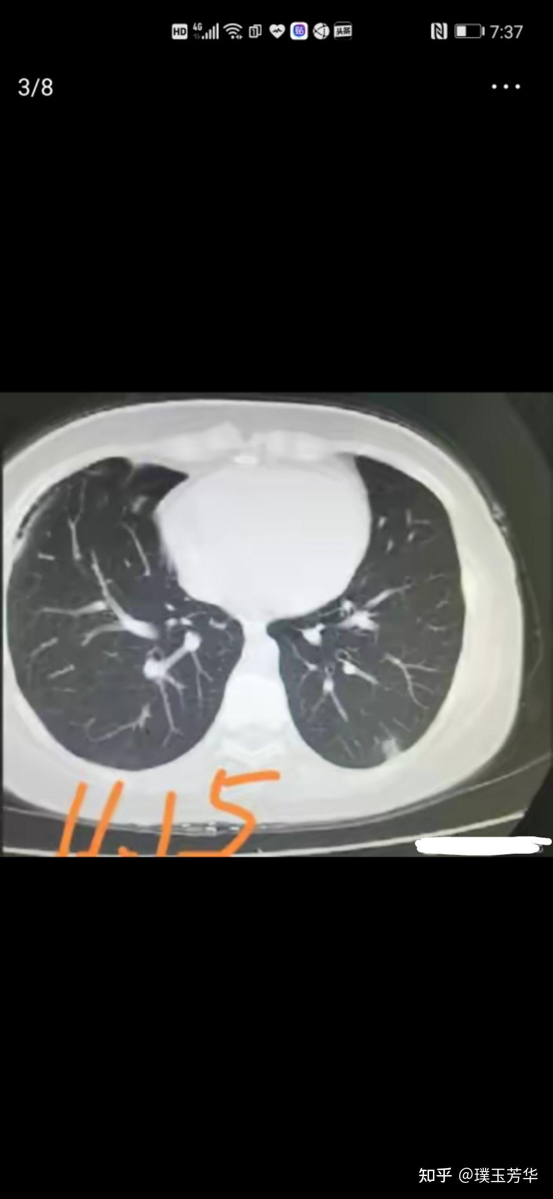 13mm肺混合磨玻璃结节图片