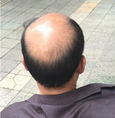 哪些原因引起男性秃顶
