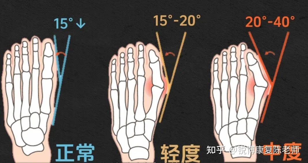 拇指外翻有必要纠正么? - 知乎