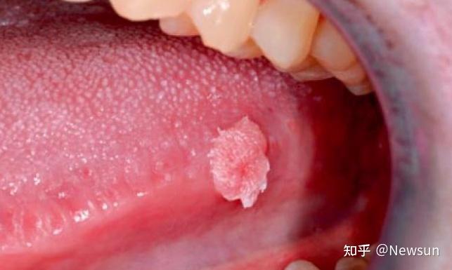 口腔感染hpv有哪些症状?(附图片)