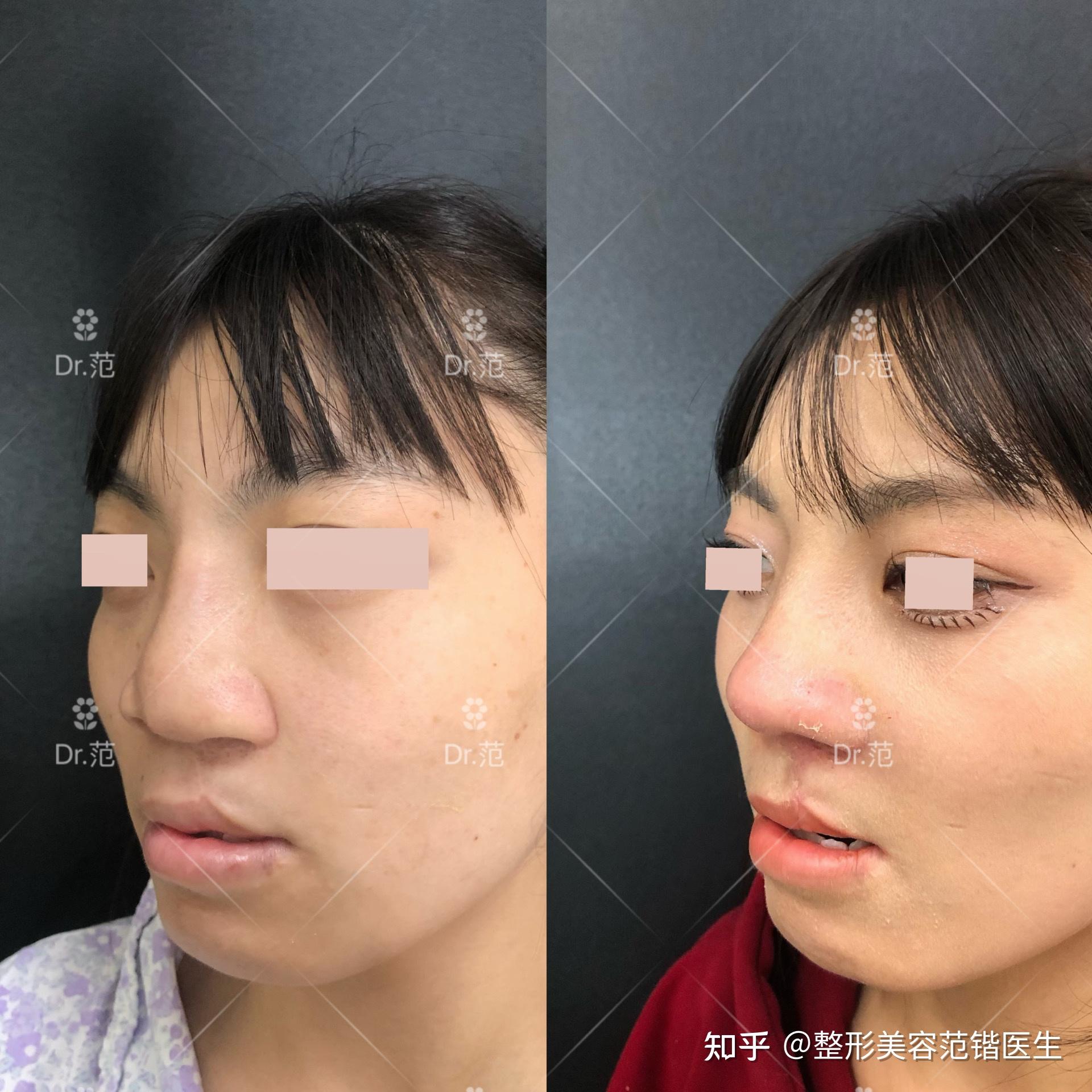 唇裂鼻畸形二期修复重建