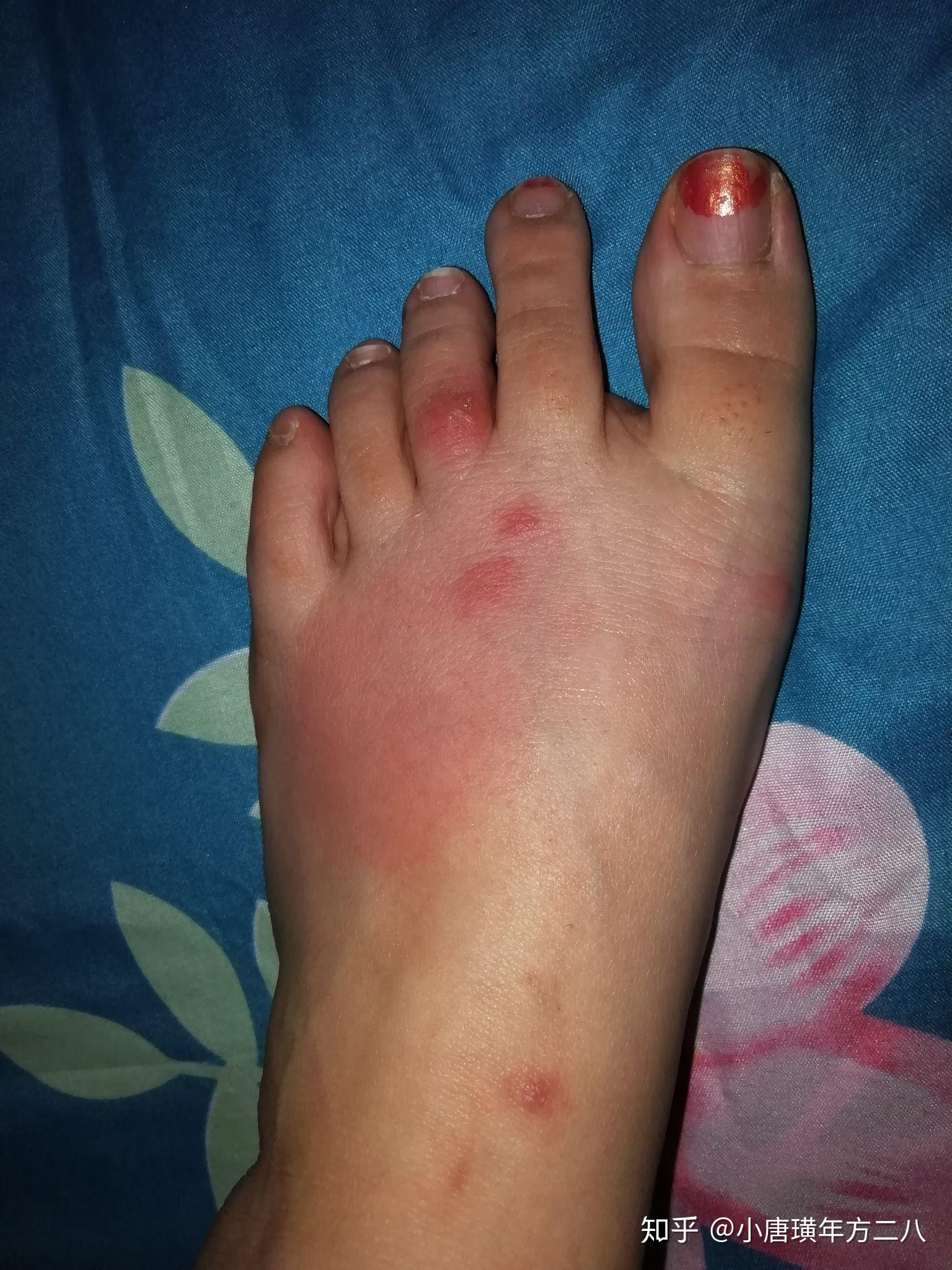 为什么有的人被蚊子咬后是起一个大包,有的人则是出现一个红点?