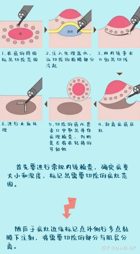 专家带你了解内镜黏膜下剥离术esd