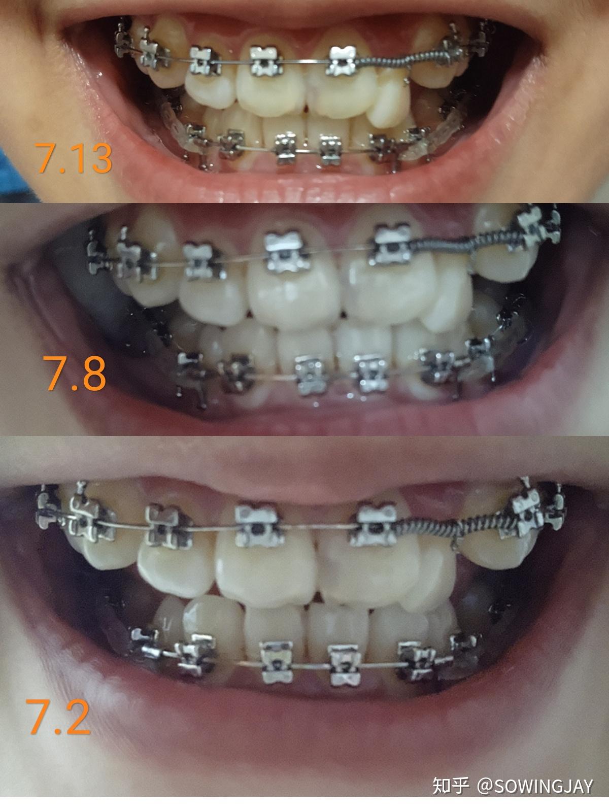 HST 全金属托槽正畸模型 B9-01