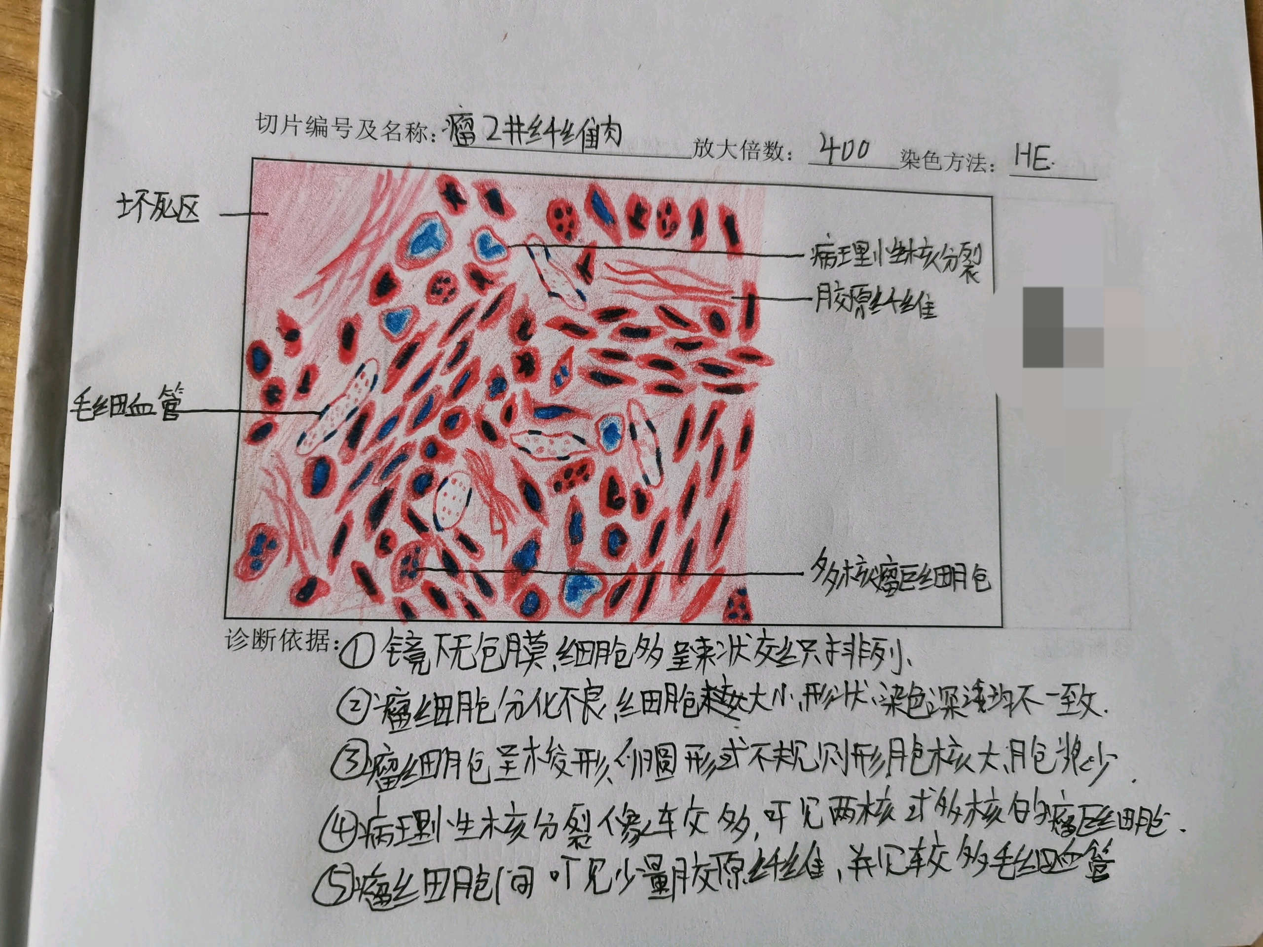 纤维瘤,纤维肉瘤镜下红蓝铅笔手绘图 