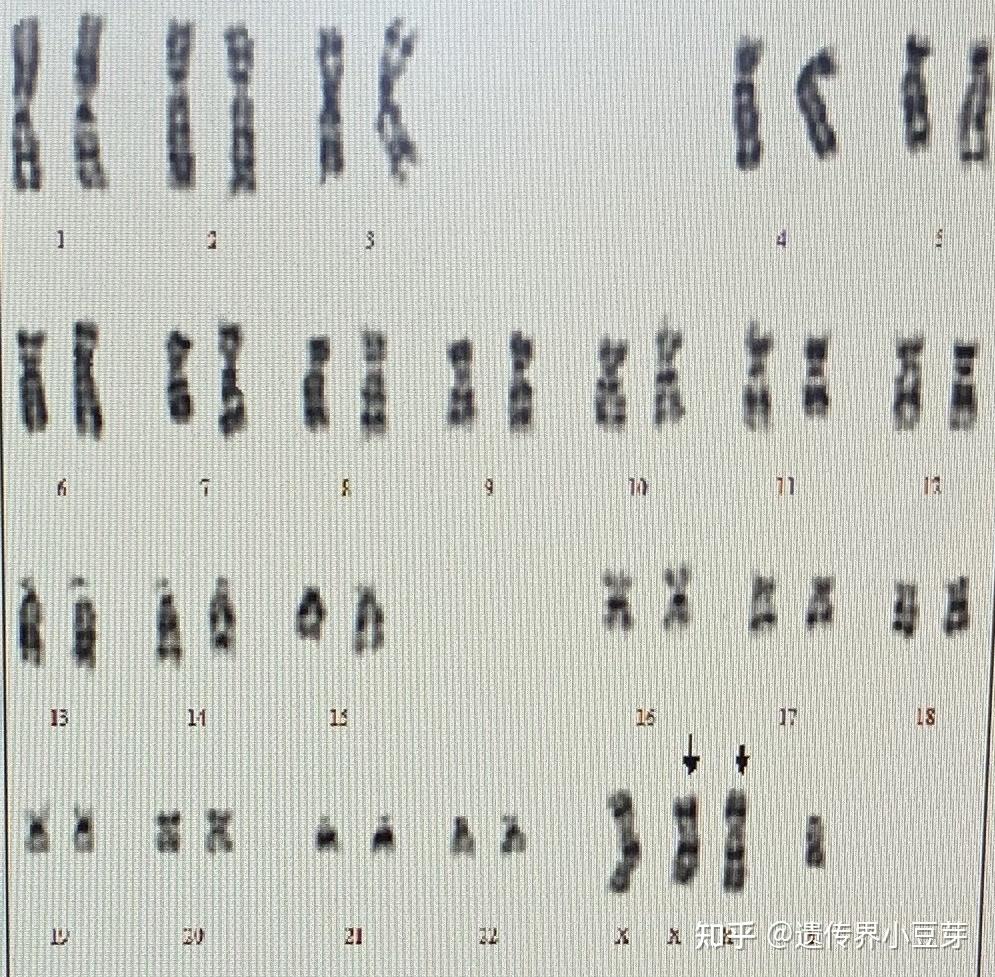 XXY染色体人的特征图片