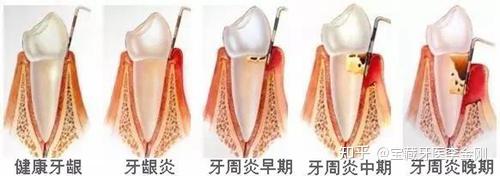 怎么判断自己是否得了牙周炎，患了牙周炎如何治疗？ - 知乎