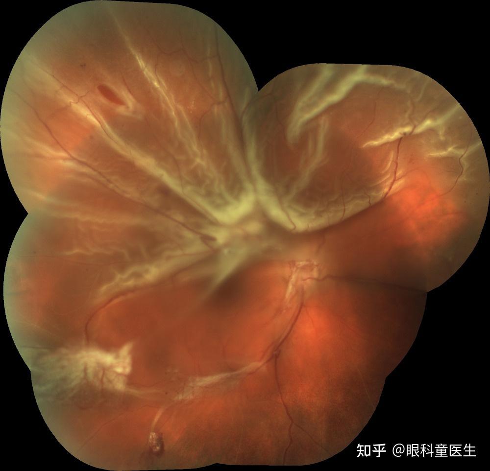 孔源性視網膜脫離(rhegmatogenous retinal detachment, rrd)