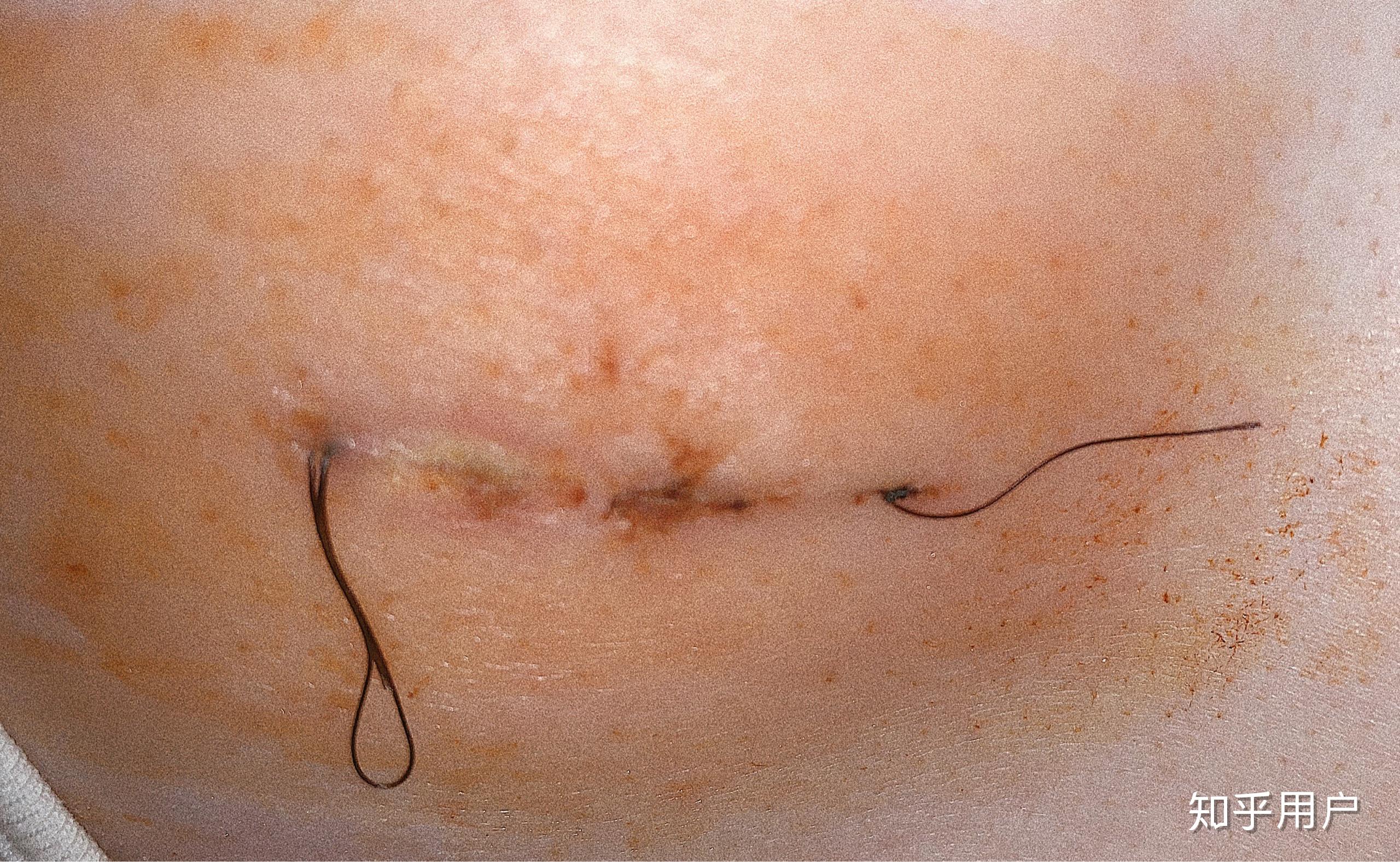 有没有女孩子得过乳腺纤维瘤啊