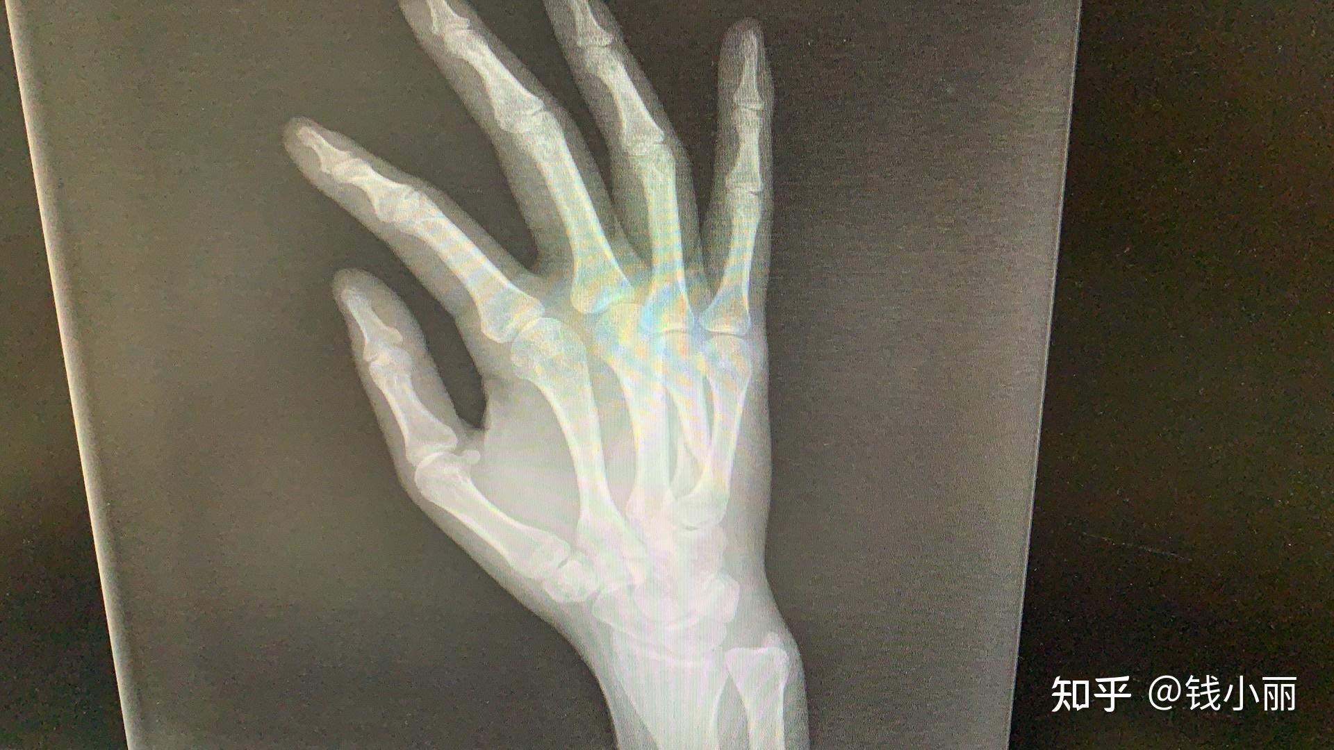右手第5掌骨骨折一例 - 病例中心(诊疗助手) - 爱爱医医学网
