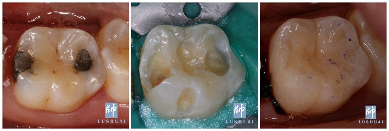 如果你嘴巴里面有这样的黑色材料可以考虑重新补了