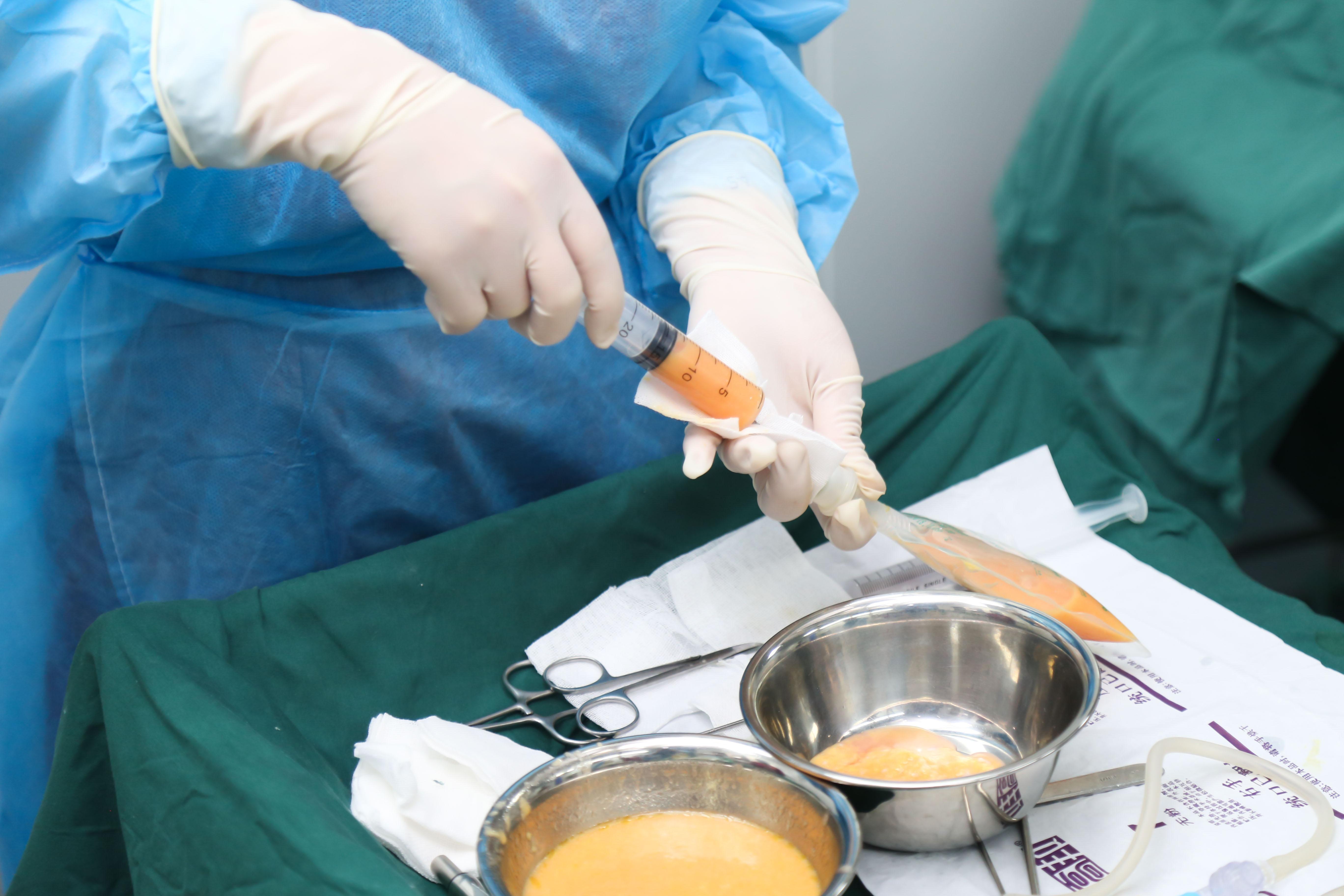 做了自体脂肪丰胸手术是怎样的体验